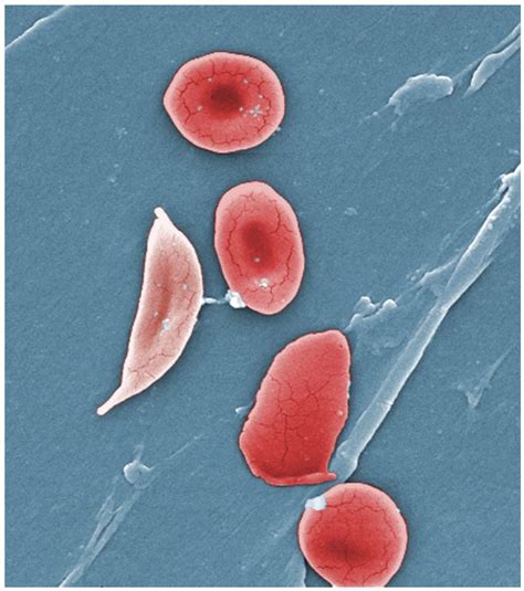 Anemia, Sickle Cell; Hemoglobin S Disease