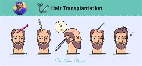 How is Hair Transplant performed in Navi Mumbai?