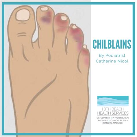 Chilblains | Risks, Prevention and Treatment of Chilblains