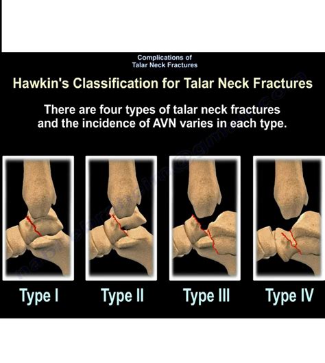 Complications of Talar Neck Fractures — OrthopaedicPrinciples.com