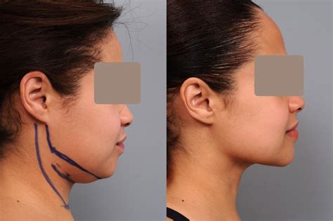 Face Liposuction Before And After