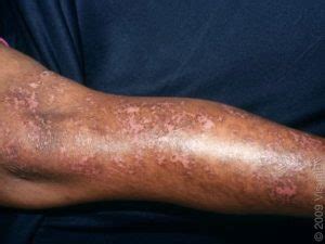 A 71-Year-Old with Diabetes and Discoloration of the Skin - Journal of Urgent Care Medicine