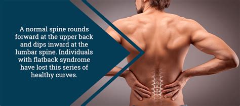 Flatback Syndrome: When a “Straight” Spine is Abnormal | JLMD