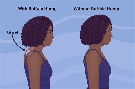 Neck Hump Causes, Prevention, and Solutions