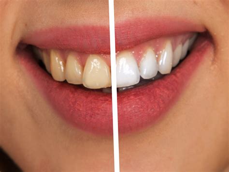 Hydrogen Peroxide Teeth Before After