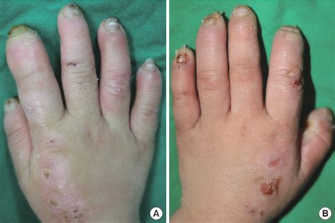 Figure 1 from Congenital Insensitivity to Pain and Anhidrosis | Semantic Scholar