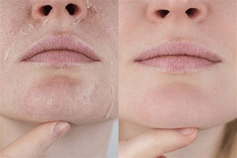 Dry Vs Dehydrated Skin…What Are The Differences? | myeppo.