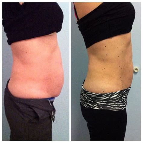 Lila Body Contouring Laser of a female abdomen, before & after #lilabodycontouringlaser # ...