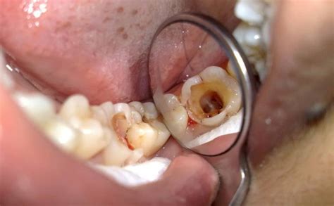 The pulp of the tooth is necrotic due to chronic pulpitis | Vinmec