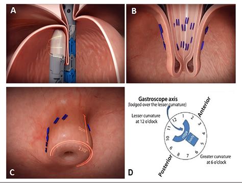 Figure 1 from Response of Laryngopharyngeal Symptoms to Transoral Incisionless Fundoplication in ...