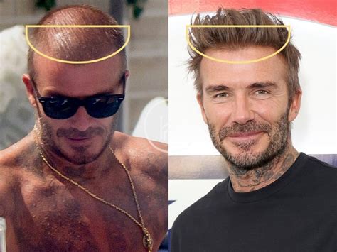 David Beckham Hair Transplant - Hair Loss & Technical Analysis