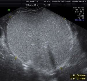 Ovarian Cysts - Womens Ultrasound ClinicWomens Ultrasound Clinic