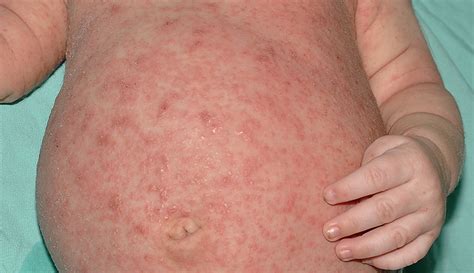 Rashes That Look Like Scabies Causes Symptoms And Tre - vrogue.co