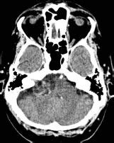 Acoustic neuroma CT - wikidoc