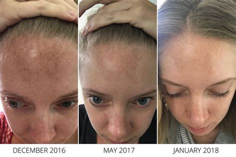 The One K-beauty Product That's An Amazing Melasma Treatment