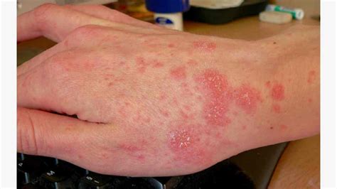 What are Scabies prevention?