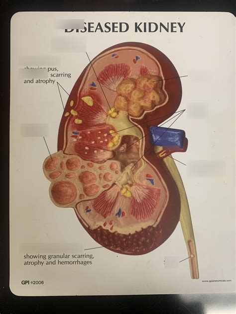 Diseased Kidney Diagram | Quizlet