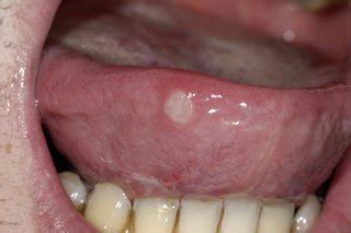 Mouth ulcers - HSE.ie