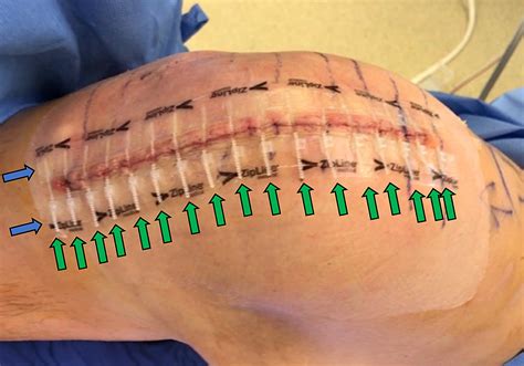 Cureus | Patient Satisfaction and Cosmetic Outcome in a Randomized, Prospective Study of Total ...