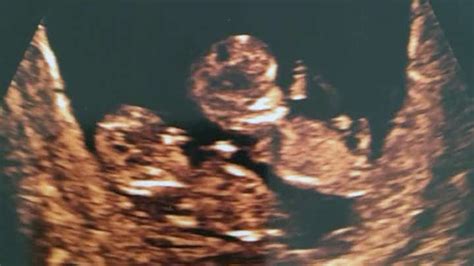 Twin Ultrasound 12 Weeks: Dating & Chorionicity Scan – About Twins