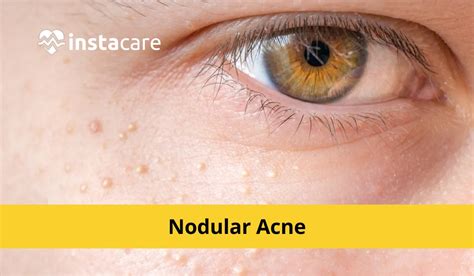 Nodular Acne: Causes, Treatment, Home Remedies And Prevention Zwivel ...