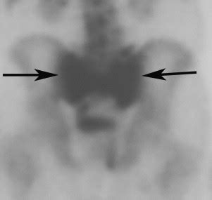 Sacral Fractures and Sacroplasty | Radiology Key