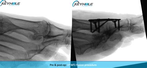 Hallux Rigidus Surgery | Perth Podiatric Surgery