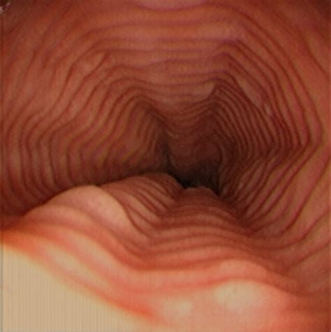 Esophagus: Felinization