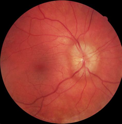 Finding Multiple Sclerosis During Your Eye Exam - Eyedolatry