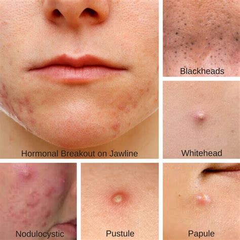 Different Types Of Acne Bumps