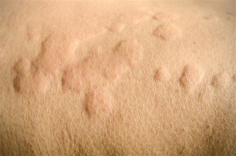 Why Is My Skin So Itchy And Hives at Aaron Dugger blog