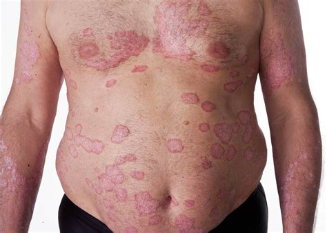 What is Psoriasis and How it is Treated in Homeopathy?
