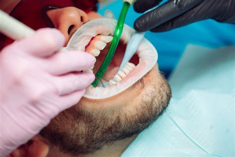 Professional Teeth Cleaning. Dentist Cleans the Teeth of a Male Patient. Stock Image - Image of ...