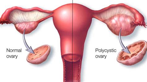 Polycystic ovary syndrome - Expert Chikitsa