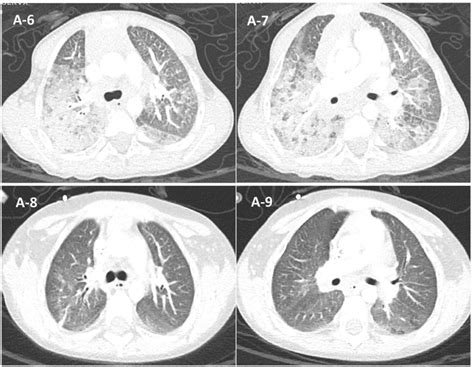 Chest CT of patient A. A-6, A-7: Discovery of infiltrative lung... | Download Scientific Diagram