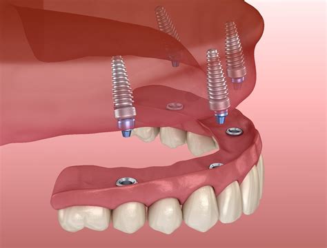 Does Blue Cross Insurance Cover Dental Implants - saintjohn