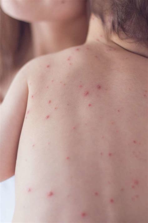 Chickenpox vs. measles: Symptoms, pictures, treatment, and more