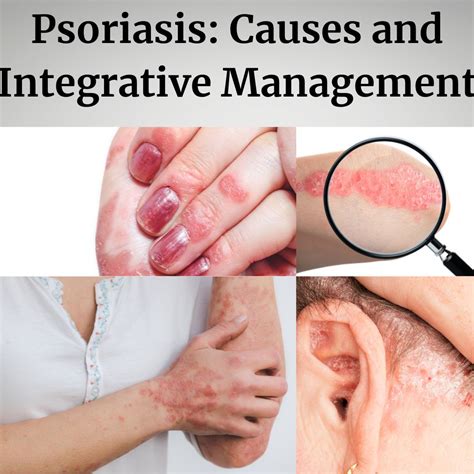 Treat Psoriasis