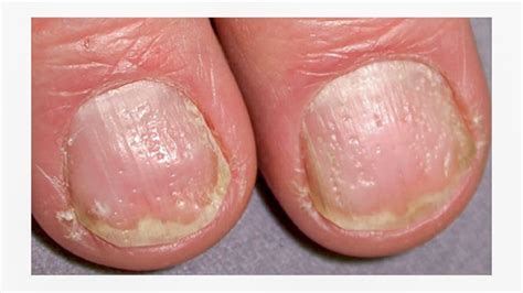Nail Psoriasis | Nail psoriasis, Nail disorders, Psoriasis disease