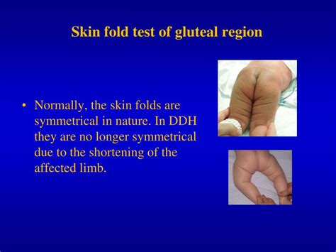 PPT - Develompmental Dysplasia of the Hip (DDH) . As. Prof. Igor Kulyanda PowerPoint ...