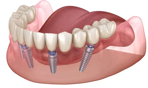 Everything You Need to Know About All on 4 Dentures - Pittsburgh ...