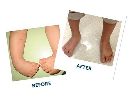 Ponseti club foot treatment 209255-Ponseti clubfoot treatment - Ikiblogrxpl