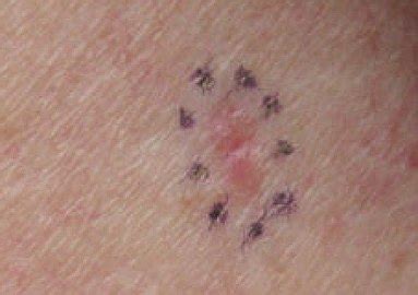 Basal-cell carcinoma | Eymaps