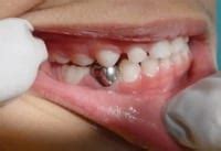 Stainless Steel Crowns for Baby Teeth | The Good Dentist