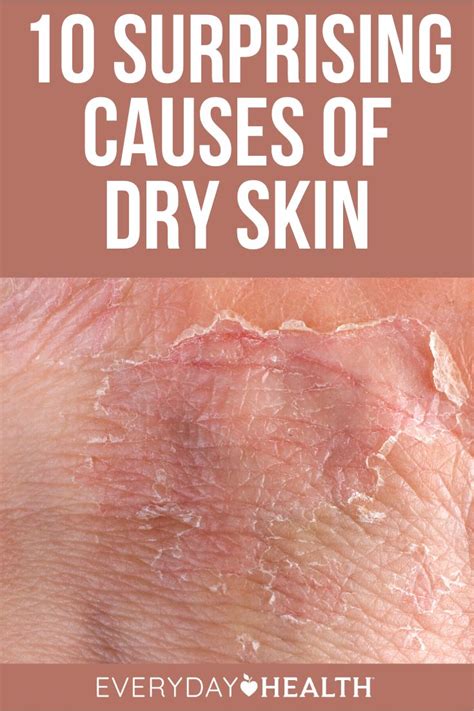 10 Surprising Causes of Dry Skin | Everyday Health | Dry itchy skin, Dry skin, Relieve dry skin