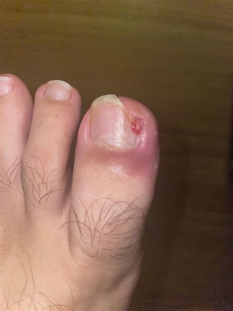 Is this normal one year after phenol matrixectomy? : r/Ingrown_Toenails