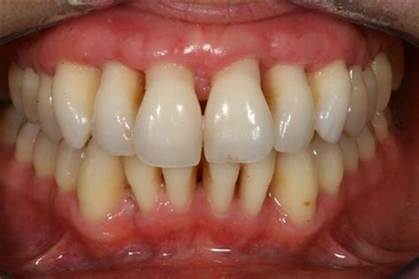 Les Dangers des poches gingivales profondes-préservez vos Dentspréservez vos dents | Marjolein