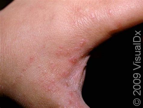 How To Identify Scabies: Symptoms, Pictures, Causes, And More | atelier-yuwa.ciao.jp