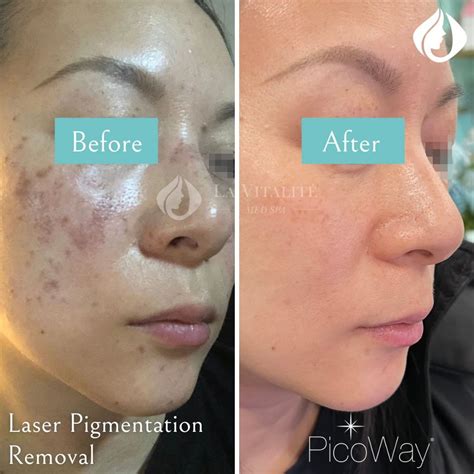 PicoWay® Laser Pigmentation Removal Toronto & North York - La Vitalité ...