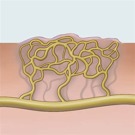 Lymphatic Malformation (LM) | Johns Hopkins Medicine Health Library